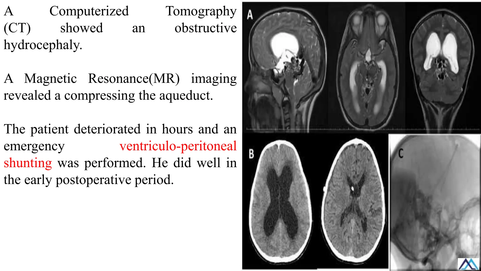 A Computerized Tomography
(CT) showed an obstructive
hydrocephaly.
A Magnetic Resonance(MR) imaging
revealed a compressing the aqueduct.
The patient deteriorated in hours and an
emergency ventriculo-peritoneal
shunting was performed. He did well in
the early postoperative period.
 