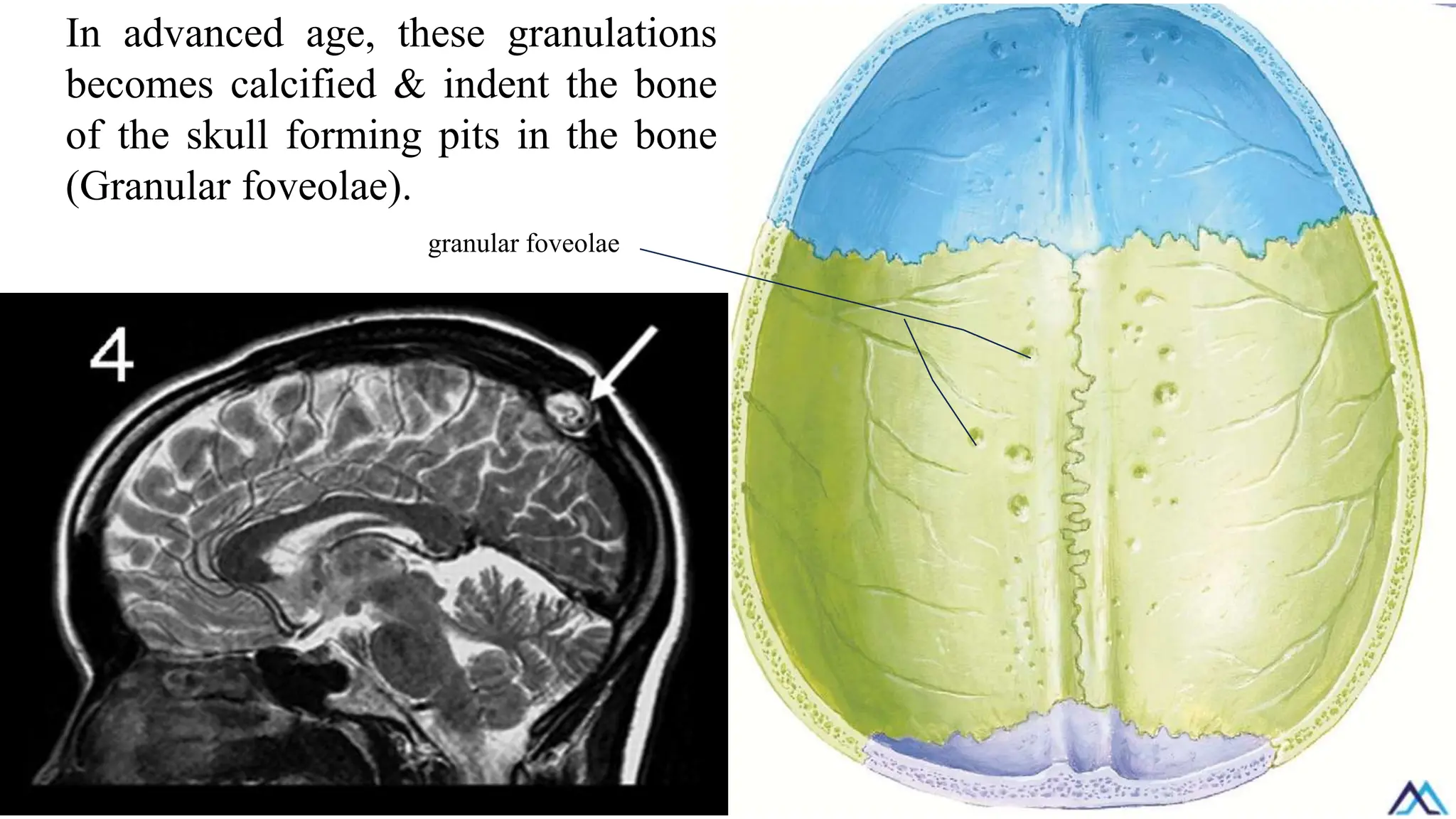 In advanced age, these granulations
becomes calcified & indent the bone
of the skull forming pits in the bone
(Granular foveolae).
granular foveolae
 