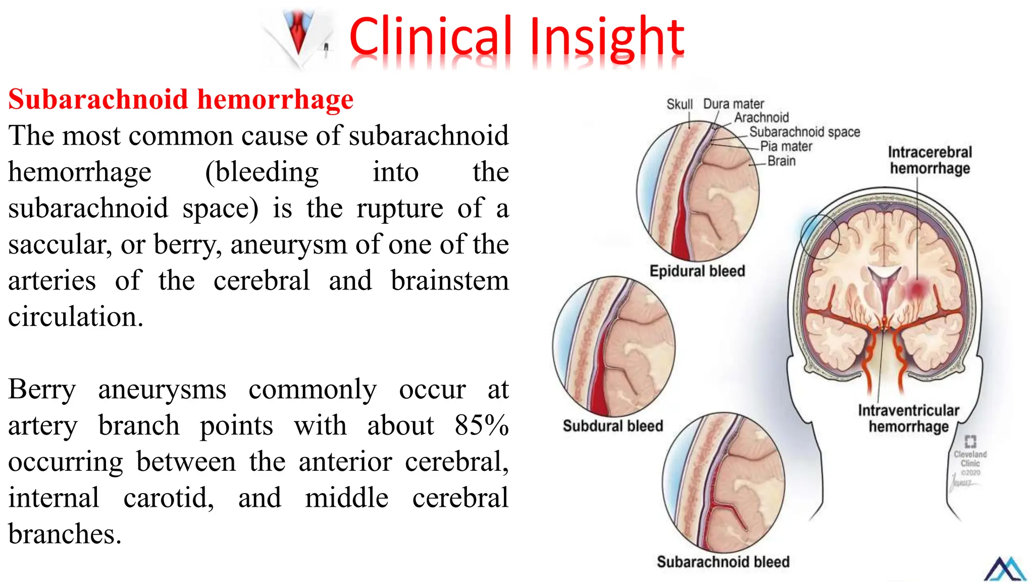 Subarachnoid hemorrhage
The most common cause of subarachnoid
hemorrhage (bleeding into the
subarachnoid space) is the rupture of a
saccular, or berry, aneurysm of one of the
arteries of the cerebral and brainstem
circulation.
Berry aneurysms commonly occur at
artery branch points with about 85%
occurring between the anterior cerebral,
internal carotid, and middle cerebral
branches.
Clinical Insight
 