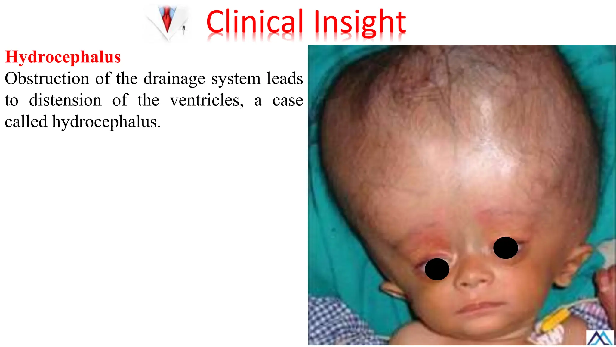 Hydrocephalus
Obstruction of the drainage system leads
to distension of the ventricles, a case
called hydrocephalus.
Clinical Insight
 