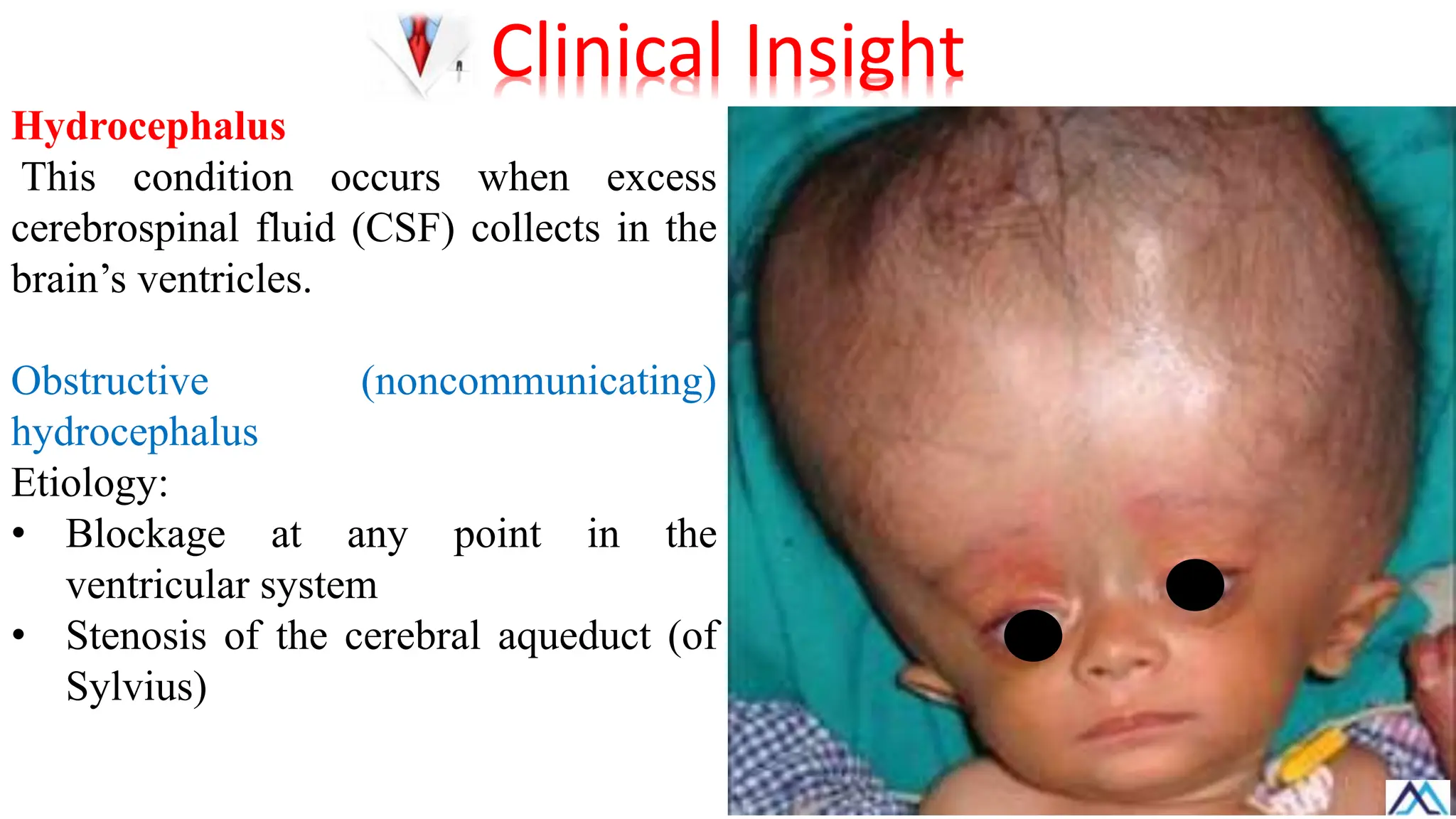 Hydrocephalus
This condition occurs when excess
cerebrospinal fluid (CSF) collects in the
brain’s ventricles.
Obstructive (noncommunicating)
hydrocephalus
Etiology:
• Blockage at any point in the
ventricular system
• Stenosis of the cerebral aqueduct (of
Sylvius)
Clinical Insight
 