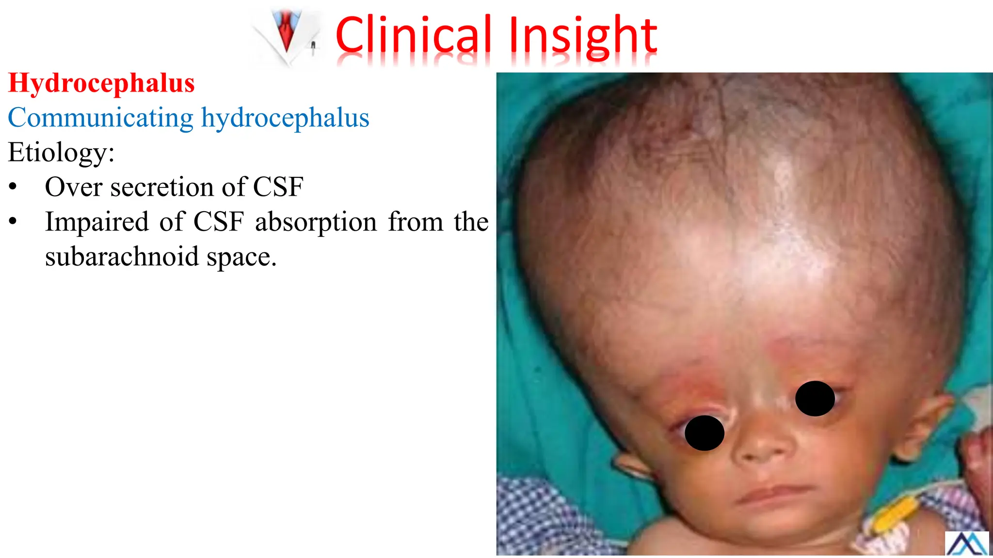 Hydrocephalus
Communicating hydrocephalus
Etiology:
• Over secretion of CSF
• Impaired of CSF absorption from the
subarachnoid space.
Clinical Insight
 