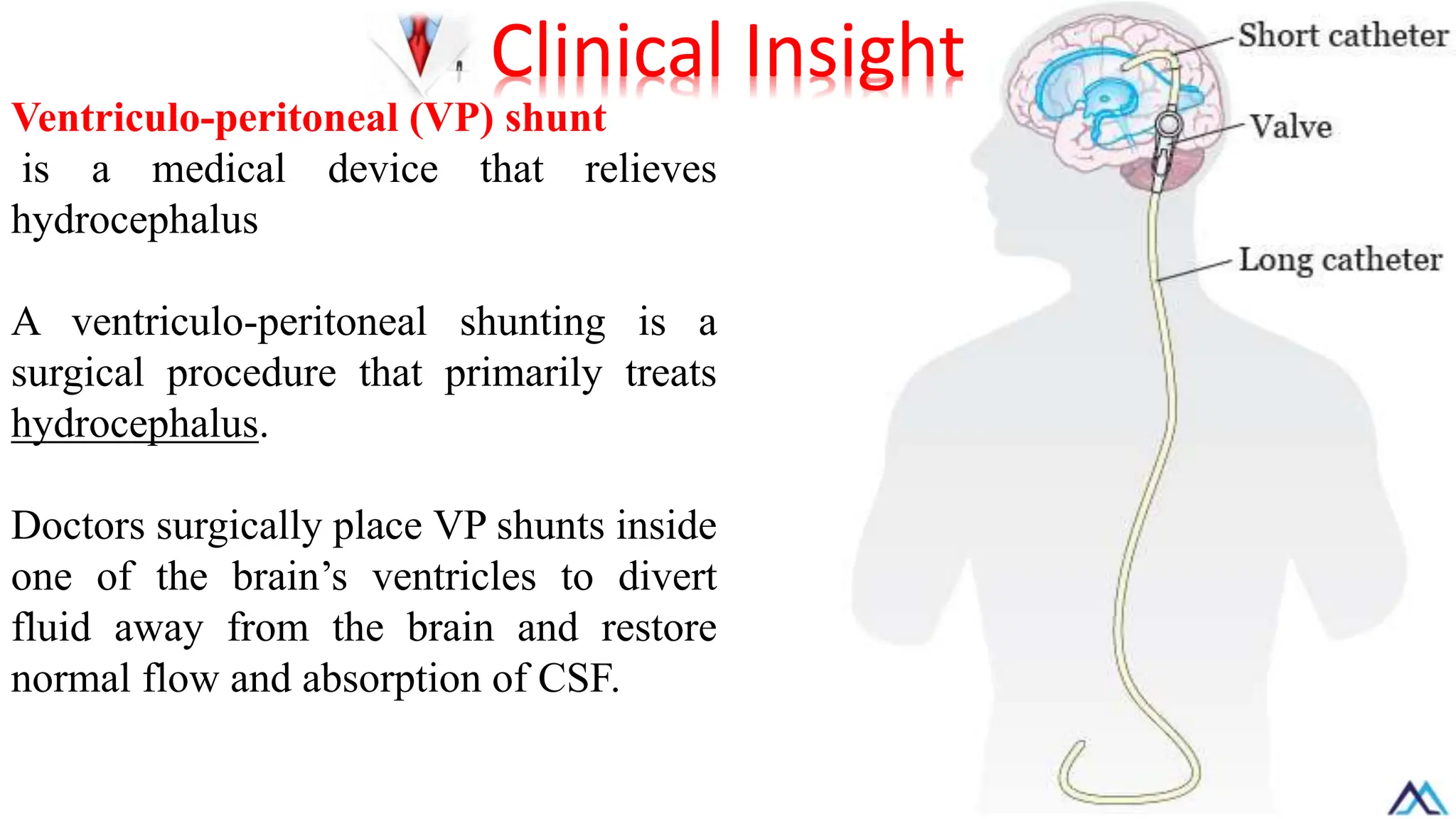 Ventriculo-peritoneal (VP) shunt
is a medical device that relieves
hydrocephalus
A ventriculo-peritoneal shunting is a
surgical procedure that primarily treats
hydrocephalus.
Doctors surgically place VP shunts inside
one of the brain’s ventricles to divert
fluid away from the brain and restore
normal flow and absorption of CSF.
Clinical Insight
 