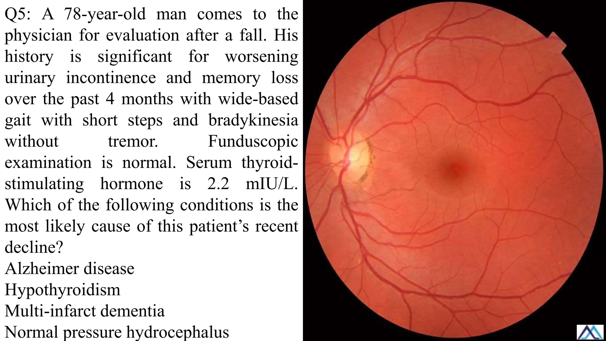 Q5: A 78-year-old man comes to the
physician for evaluation after a fall. His
history is significant for worsening
urinary incontinence and memory loss
over the past 4 months with wide-based
gait with short steps and bradykinesia
without tremor. Funduscopic
examination is normal. Serum thyroid-
stimulating hormone is 2.2 mIU/L.
Which of the following conditions is the
most likely cause of this patient’s recent
decline?
Alzheimer disease
Hypothyroidism
Multi-infarct dementia
Normal pressure hydrocephalus
 