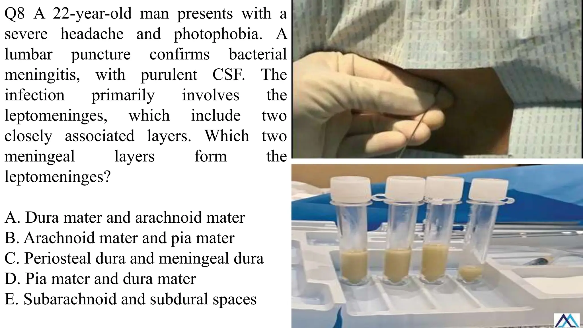 Q8 A 22-year-old man presents with a
severe headache and photophobia. A
lumbar puncture confirms bacterial
meningitis, with purulent CSF. The
infection primarily involves the
leptomeninges, which include two
closely associated layers. Which two
meningeal layers form the
leptomeninges?
A. Dura mater and arachnoid mater
B. Arachnoid mater and pia mater
C. Periosteal dura and meningeal dura
D. Pia mater and dura mater
E. Subarachnoid and subdural spaces
 