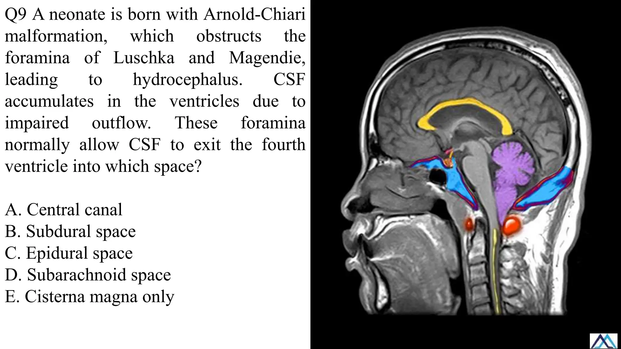 Q9 A neonate is born with Arnold-Chiari
malformation, which obstructs the
foramina of Luschka and Magendie,
leading to hydrocephalus. CSF
accumulates in the ventricles due to
impaired outflow. These foramina
normally allow CSF to exit the fourth
ventricle into which space?
A. Central canal
B. Subdural space
C. Epidural space
D. Subarachnoid space
E. Cisterna magna only
 