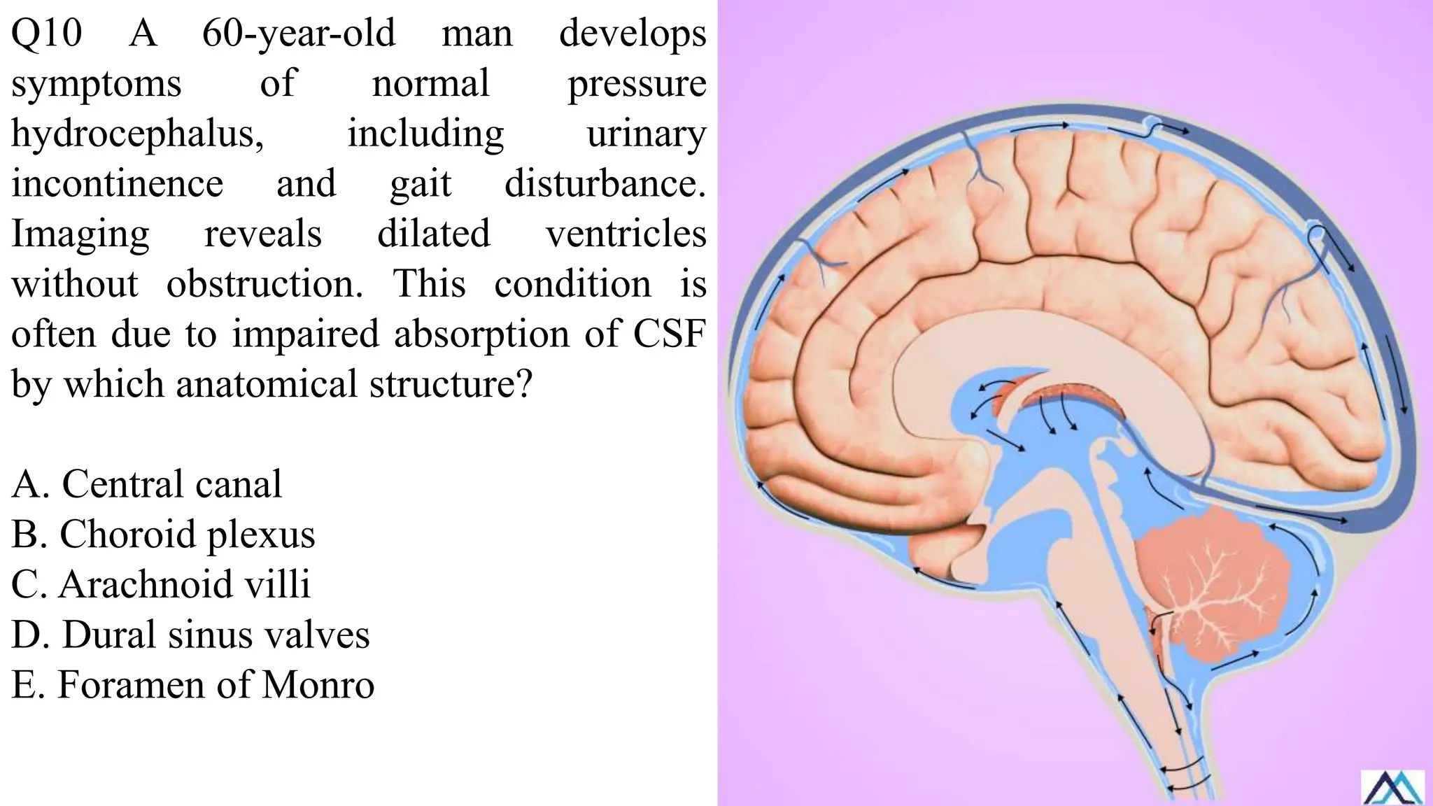 Q10 A 60-year-old man develops
symptoms of normal pressure
hydrocephalus, including urinary
incontinence and gait disturbance.
Imaging reveals dilated ventricles
without obstruction. This condition is
often due to impaired absorption of CSF
by which anatomical structure?
A. Central canal
B. Choroid plexus
C. Arachnoid villi
D. Dural sinus valves
E. Foramen of Monro
 