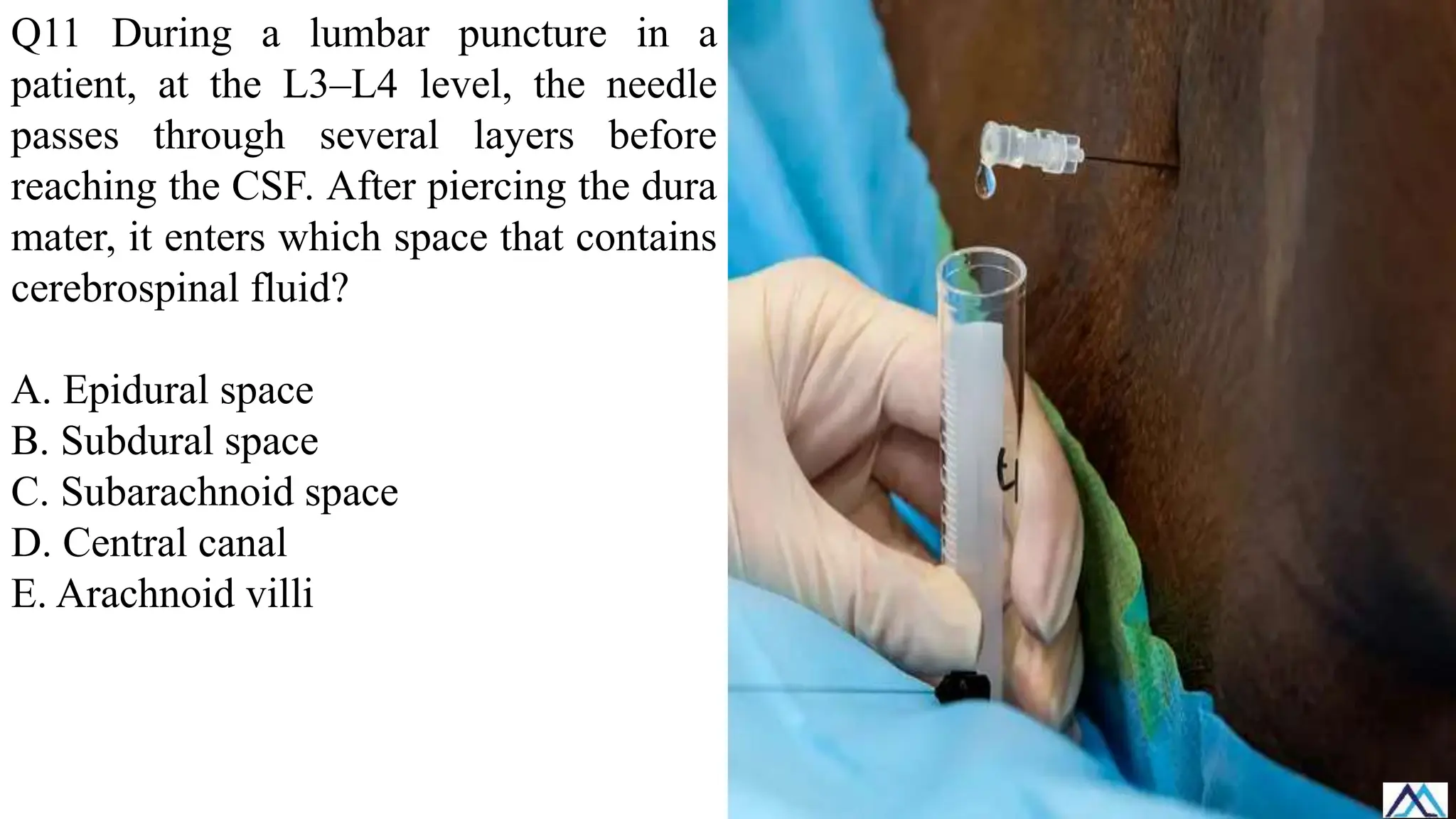 Q11 During a lumbar puncture in a
patient, at the L3–L4 level, the needle
passes through several layers before
reaching the CSF. After piercing the dura
mater, it enters which space that contains
cerebrospinal fluid?
A. Epidural space
B. Subdural space
C. Subarachnoid space
D. Central canal
E. Arachnoid villi
 