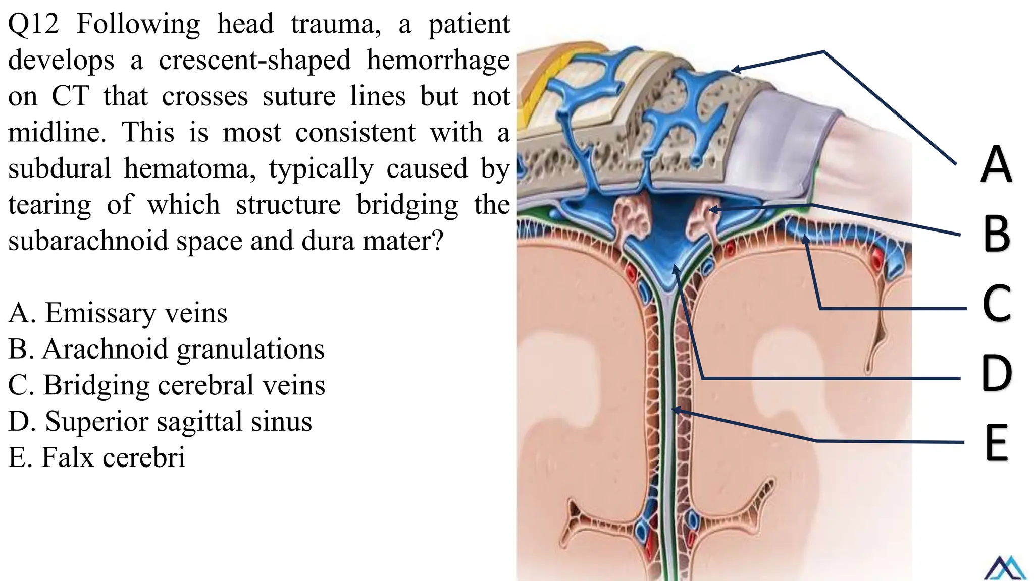 Q12 Following head trauma, a patient
develops a crescent-shaped hemorrhage
on CT that crosses suture lines but not
midline. This is most consistent with a
subdural hematoma, typically caused by
tearing of which structure bridging the
subarachnoid space and dura mater?
A. Emissary veins
B. Arachnoid granulations
C. Bridging cerebral veins
D. Superior sagittal sinus
E. Falx cerebri
A
B
C
D
E
 