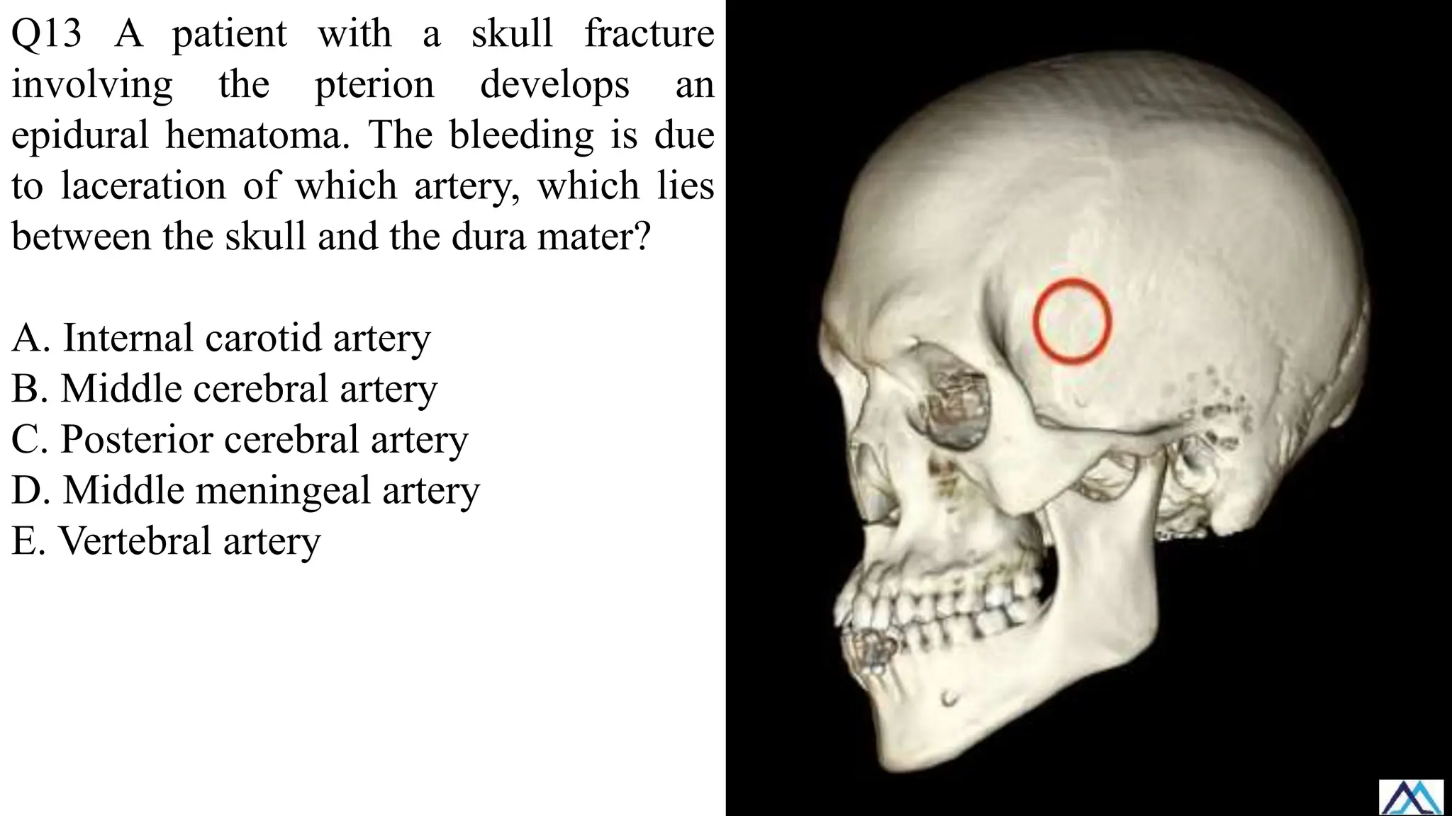 Q13 A patient with a skull fracture
involving the pterion develops an
epidural hematoma. The bleeding is due
to laceration of which artery, which lies
between the skull and the dura mater?
A. Internal carotid artery
B. Middle cerebral artery
C. Posterior cerebral artery
D. Middle meningeal artery
E. Vertebral artery
 