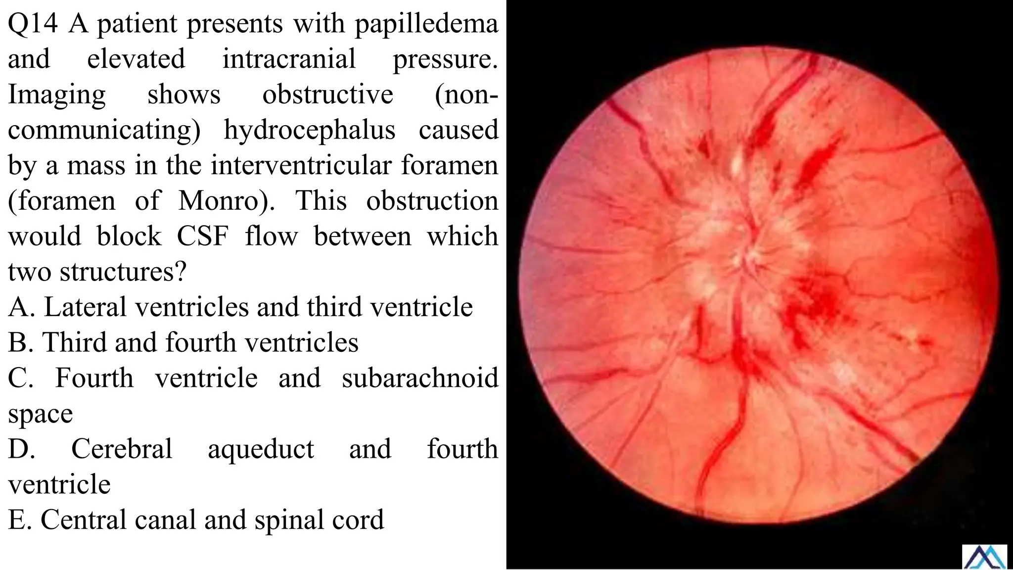 Q14 A patient presents with papilledema
and elevated intracranial pressure.
Imaging shows obstructive (non-
communicating) hydrocephalus caused
by a mass in the interventricular foramen
(foramen of Monro). This obstruction
would block CSF flow between which
two structures?
A. Lateral ventricles and third ventricle
B. Third and fourth ventricles
C. Fourth ventricle and subarachnoid
space
D. Cerebral aqueduct and fourth
ventricle
E. Central canal and spinal cord
 