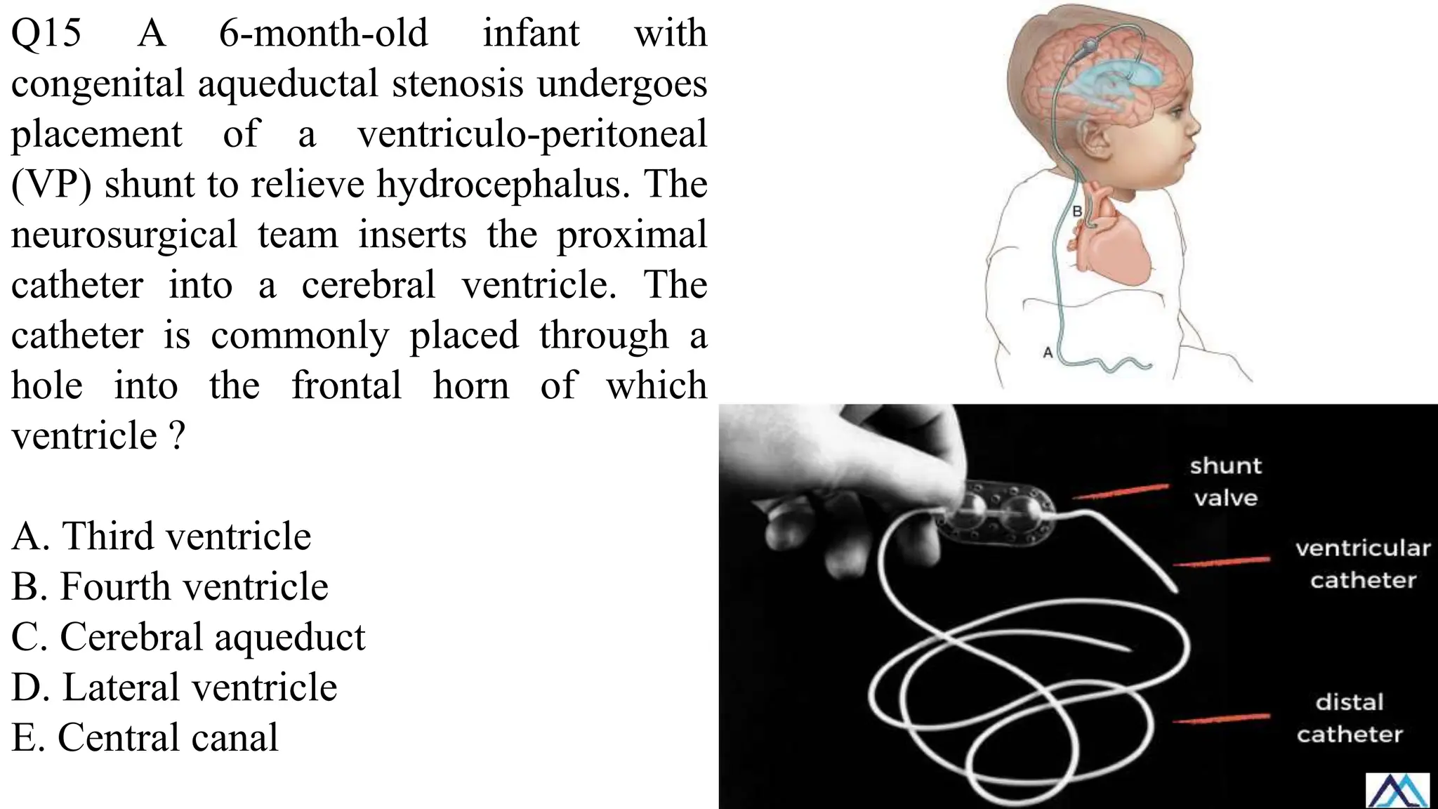 Q15 A 6-month-old infant with
congenital aqueductal stenosis undergoes
placement of a ventriculo-peritoneal
(VP) shunt to relieve hydrocephalus. The
neurosurgical team inserts the proximal
catheter into a cerebral ventricle. The
catheter is commonly placed through a
hole into the frontal horn of which
ventricle ?
A. Third ventricle
B. Fourth ventricle
C. Cerebral aqueduct
D. Lateral ventricle
E. Central canal
 