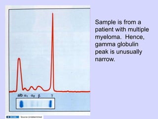 Sample is from a
                      patient with multiple
                      myeloma. Hence,
                      gamma globulin
                      peak is unusually
                      narrow.




Source Undetermined
 