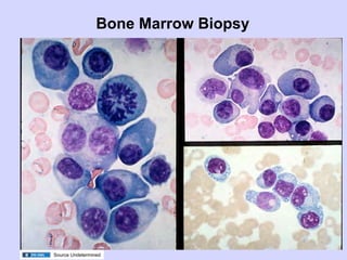 Bone Marrow Biopsy




Source Undetermined
 