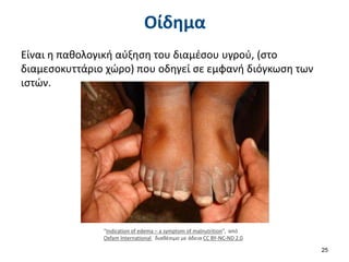 Οίδημα
Είναι η παθολογική αύξηση του διαμέσου υγρού, (στο
διαμεσοκυττάριο χώρο) που οδηγεί σε εμφανή διόγκωση των
ιστών.
25
“Indication of edema – a symptom of malnutrition”, από
Oxfam International διαθέσιμο με άδεια CC BY-NC-ND 2.0
 