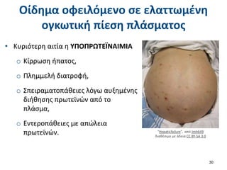 Οίδημα οφειλόμενο σε ελαττωμένη
ογκωτική πίεση πλάσματος
• Κυριότερη αιτία η ΥΠΟΠΡΩΤΕΪΝΑΙΜΙΑ
o Κίρρωση ήπατος,
o Πλημμελή διατροφή,
o Σπειραματοπάθειες λόγω αυξημένης
διήθησης πρωτεϊνών από το
πλάσμα,
o Εντεροπάθειες με απώλεια
πρωτεϊνών.
30
“Hepaticfailure”, από Jmh649
διαθέσιμο με άδεια CC BY-SA 3.0
 