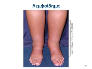 Λεμφοίδημα
32
“Primary
intestinal
lymphangiectasia
(Waldmann's
disease)
-
legs”,
από
Filip
em
διαθέσιμο
με
άδεια
CC
BY
2.0
 