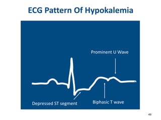 ECG Pattern Of Hypokalemia
49
Prominent U Wave
Biphasic T wave
Depressed ST segment
 