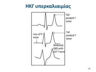 ΗΚΓ υπερκαλιαιμίας
53
Tall
peaked T
wave
Tall
peaked T
wave
Loss of P
wave
Widened
QRS with
tall T wave
 