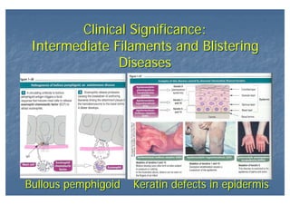 Clinical Significance:
Intermediate Filaments and Blistering
Diseases
Clinical Significance:
Intermediate Filaments and Blistering
Diseases
Bullous pemphigoidBullous pemphigoid Keratin defects in epidermisKeratin defects in epidermis
 
