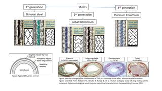 Stents1st generation
2nd generation
3rd generation
Stainless steel
Cobalt Chromium
Platinum Chromium
Figure: Typical DES, cross-section
Figure: Vascular changes after implantation of DES in a coronary vessel after atherosclerosis formation
Figure collected from, Nakano M, Otsuka F, Yahagi K, et al. Human autopsy study of drug-eluting stents
restenosis: histomorphological predictors and neointimal characteristics. European Heart Journal. 2013
 
