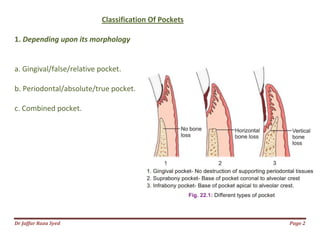 023.periodontal pocket | PDF