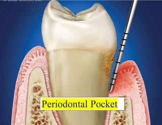 Classification and Treatment of Periodontal Pockets | PPT