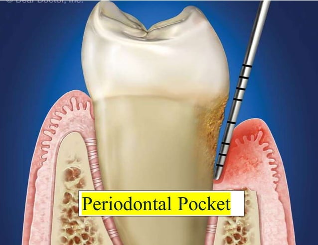 periodontal pocket | DOCX
