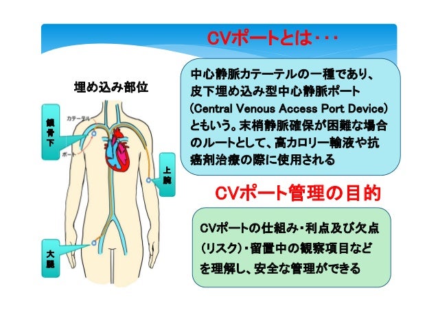ポート 看護 Cv CVポートからの点滴を週に3回している方は、特別訪問看護指示