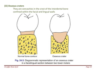 Dr Jaffar Raza Syed
(iii) Osseous craters
They are concavities in the crest of the interdental bone
confined within the facial and lingual walls
They are concavities in the crest of the interdental bone
confined within the facial and lingual walls
Page 10
 