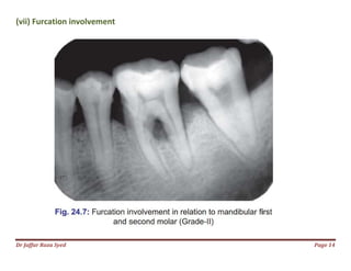 Dr Jaffar Raza Syed
(vii) Furcation involvement
Page 14
 