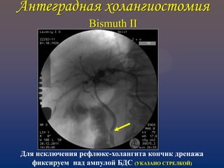 Антеградная холангиостомия
Bismuth II
Для исключения рефлюкс-холангита кончик дренажа
фиксируем над ампулой БДС (УКАЗАНО СТРЕЛКОЙ)
 