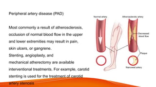Peripheral artery disease (PAD)
Most commonly a result of atherosclerosis,
occlusion of normal blood flow in the upper
and lower extremities may result in pain,
skin ulcers, or gangrene.
Stenting, angioplasty, and
mechanical atherectomy are available
interventional treatments. For example, carotid
stenting is used for the treatment of carotid
artery stenosis
 