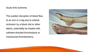 Acute limb ischemia
The sudden disruption of blood flow
to an arm or a leg due to arterial
occlusion by a blood clot or other
debris, potentially be treated with
catheter-directed thrombolysis or
mechanical thrombectomy.
 