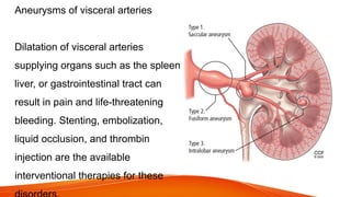 Aneurysms of visceral arteries
Dilatation of visceral arteries
supplying organs such as the spleen,
liver, or gastrointestinal tract can
result in pain and life-threatening
bleeding. Stenting, embolization,
liquid occlusion, and thrombin
injection are the available
interventional therapies for these
 