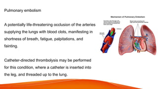 Pulmonary embolism
A potentially life-threatening occlusion of the arteries
supplying the lungs with blood clots, manifesting in
shortness of breath, fatigue, palpitations, and
fainting.
Catheter-directed thrombolysis may be performed
for this condition, where a catheter is inserted into
the leg, and threaded up to the lung.
 