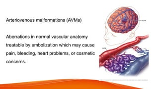 Arteriovenous malformations (AVMs)
Aberrations in normal vascular anatomy
treatable by embolization which may cause
pain, bleeding, heart problems, or cosmetic
concerns.
 