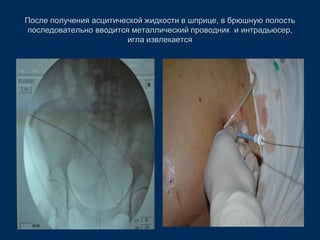 После получения асцитической жидкости в шприце, в брюшную полость
последовательно вводится металлический проводник и интрадьюсер,
игла извлекается
 