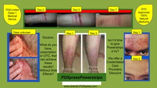 Day 3 Day 7Day 2
Day 1
Day 4
Days unknown Day 1 Day 3
www.shaneh.FGXpress.com
FDA-Listed
Class 1
Medical
Device
OTC
Approved
100%
Natural
Medicine
Doctors:
What do you
have,
prescription
or OTC, that
can achieve
these
results?
Without Side
Effects?
Isn’t it time
to give
Powerstrips
a try?
We offer a
Credentialed
Care
Providers
Discount
FGXpressPowerstrips
 