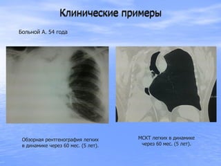 Клинические примеры
Обзорная рентгенография легких
в динамике через 60 мес. (5 лет).
Клинические примеры
Больной А. 54 года
МСКТ легких в динамике
через 60 мес. (5 лет).
 