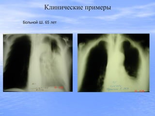 Клинические примеры
Больной Ш. 65 лет
 