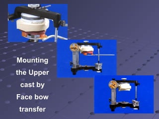 Mounting
the Upper
cast by
Face bow
transfer
 