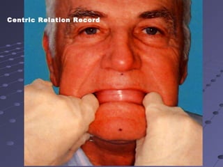 Centric Relation Record
 