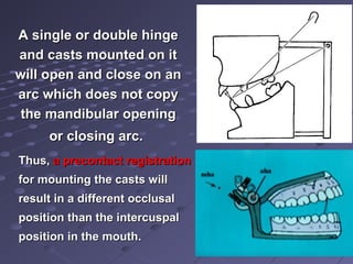 Thus,Thus, a precontact registrationa precontact registration
for mounting the casts willfor mounting the casts will
result in a different occlusalresult in a different occlusal
position than the intercuspalposition than the intercuspal
position in the mouth.position in the mouth.
A single or double hingeA single or double hinge
and casts mounted on itand casts mounted on it
will open and close on anwill open and close on an
arc which does not copyarc which does not copy
the mandibular openingthe mandibular opening
or closing arc.or closing arc.
 