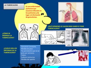 LA TUBERCULOSIS
Es una enfermedad
pulmonar que
ocasiona infección en
los pulmones y da
lugar a la formación
de granulomas.
¿CÓMO SE
PROPAGA LA
TUBERCULOSIS?
¿CUÁLES SON LOS
SÍNTOMAS DE LA
TUBERCULOSIS?
Cansancio constante.
Pérdida de peso .
Tos persistente que no se
quita por semanas.
Fiebre .
Sudores nocturnos.
Pérdida del apetito
¿QUÉ EXÁMENES SE HACEN PARA SABER SI TIENE
TUBERCULOSIS?
 