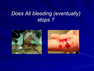Does All bleeding (eventually)
           stops ?
 