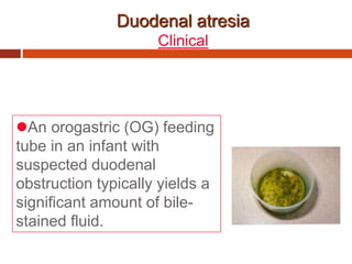 Duodenal atresia
Clinical
An orogastric (OG) feeding
tube in an infant with
suspected duodenal
obstruction typically yields a
significant amount of bile-
stained fluid.
 
