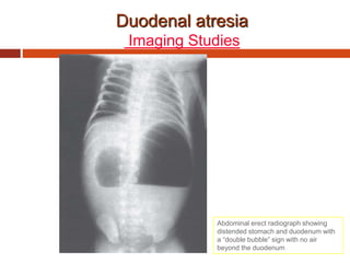 Duodenal atresia
Imaging Studies
Abdominal erect radiograph showing
distended stomach and duodenum with
a “double bubble” sign with no air
beyond the duodenum
 