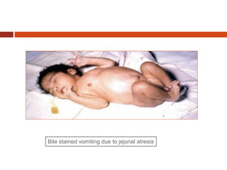 Bile stained vomiting due to jejunal atresia
 