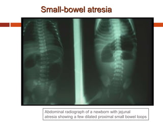 Small-bowel atresia
Abdominal radiograph of a newborn with jejunal
atresia showing a few dilated proximal small bowel loops
 